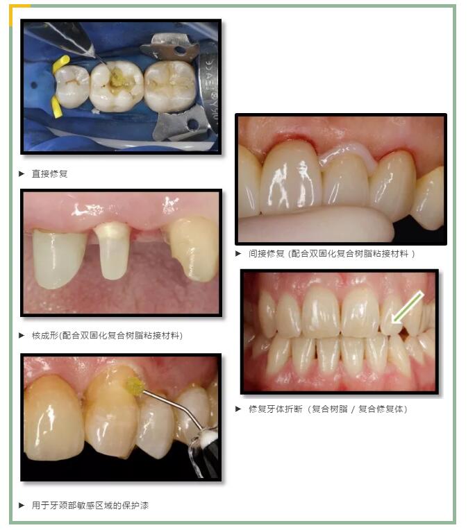 义获嘉Tetric® N Bond Universal第八代粘接剂