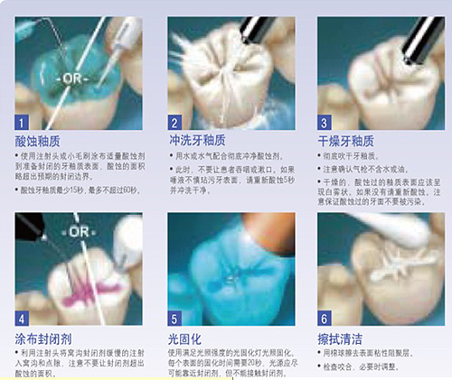 3M Clinpro Sealant 变色窝沟封闭剂