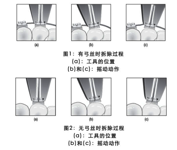 3M Unitek Gemini Clear MBT直丝弓陶瓷托槽 3M Unitek Gemini Clear MBT直丝弓陶瓷托槽