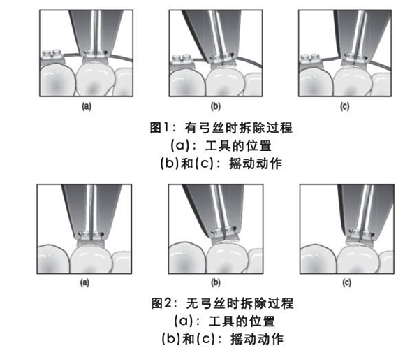 3M Clarity Advanced MBT直丝弓陶瓷托槽 5x5陶瓷