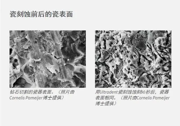 皓齿陶瓷酸蚀剂1.webp