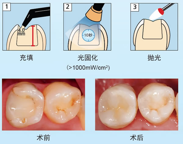 义获嘉 Tetric N-Ceram Bulk Fill 3次方大块充填树脂 IVA