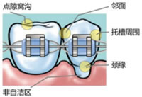 义获嘉 氟齿乐