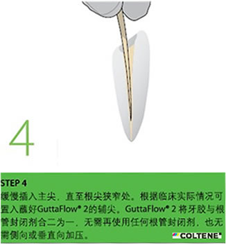 康特 GuttaFlow 2根管充填常温流动牙胶4.jpg 康特 GuttaFlow 2根管充填常温流动牙胶4.jpg