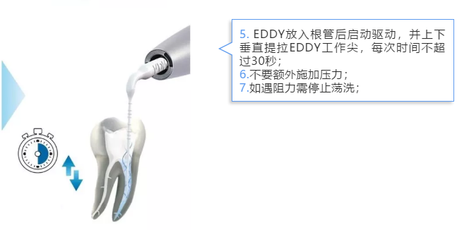 VDW EDDY 声波荡洗工作尖e.png