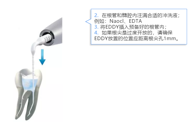 VDW EDDY 声波荡洗工作尖d.png