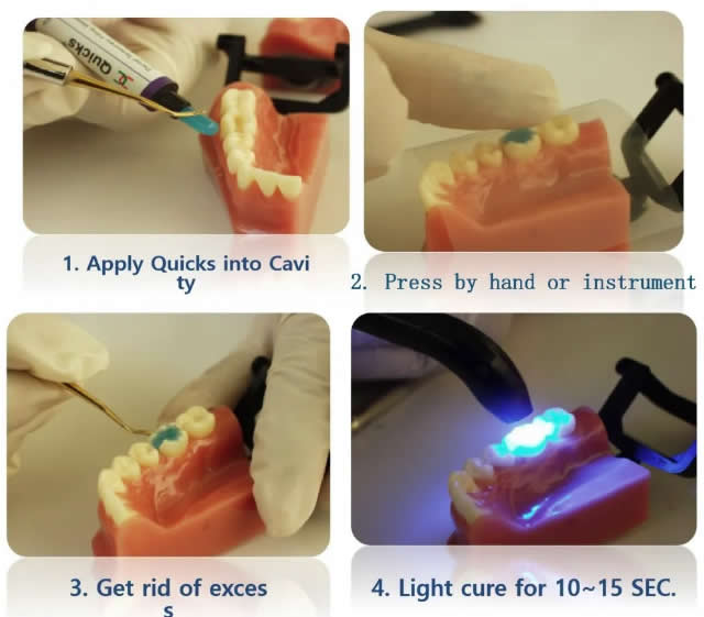 DENKSIT—Quick光固化临时充填材料3.jpg