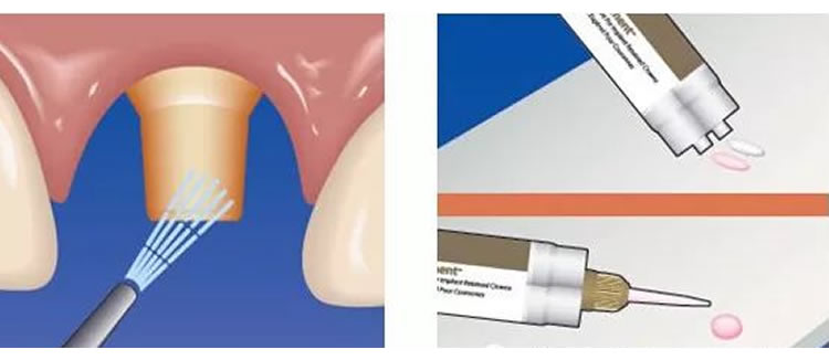 普米尔 Premier Implant Cement种植粘接剂全接触_r2_c1.jpg