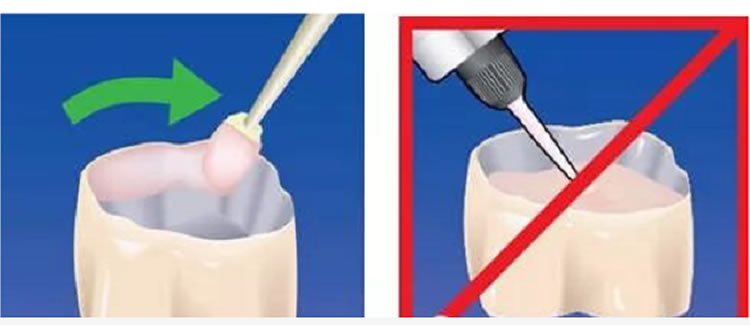 普米尔 Premier Implant Cement种植粘接剂全接触_r3_c1.jpg