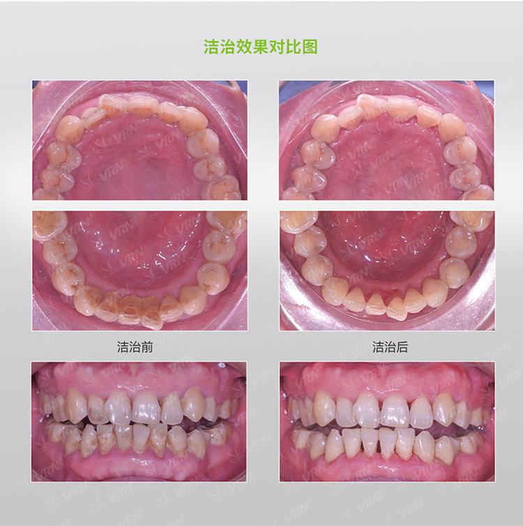 维润 超声喷砂牙周治疗仪VRN-Q6-2_r5_c1.jpg