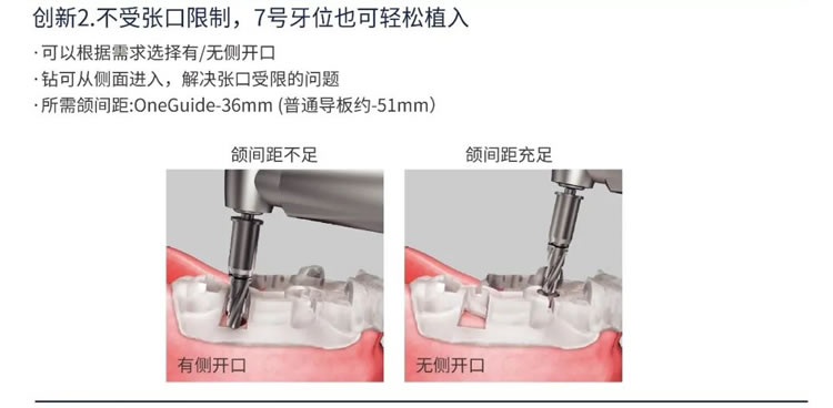 奥齿泰  导板工具盒  One Guide KIT-1_r2_c1.jpg