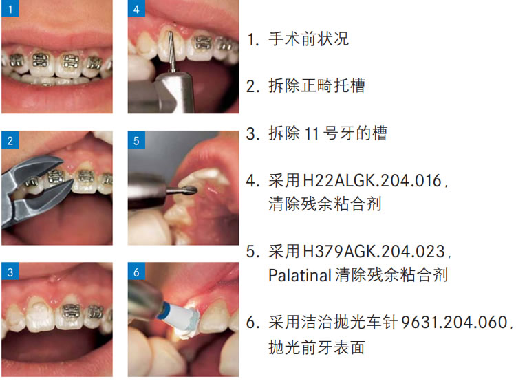 固美 粘结剂清楚车针a.jpg 固美 粘结剂清楚车针a.jpg