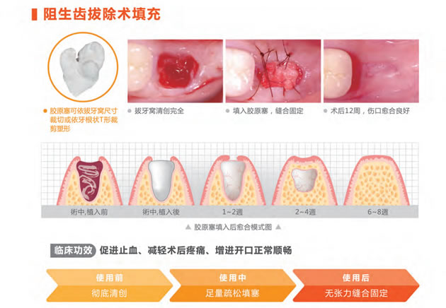 愈立安胶原蛋白塞b.jpg