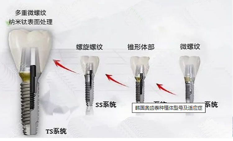 奥齿泰 TSIII SA 种植体1_r1_c1.jpg