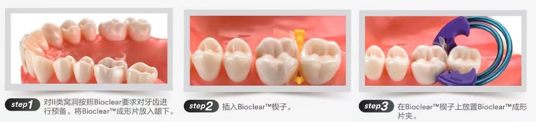 3M ESPE Bioclear牙科成形片套装(后牙）827051-2.jpg
