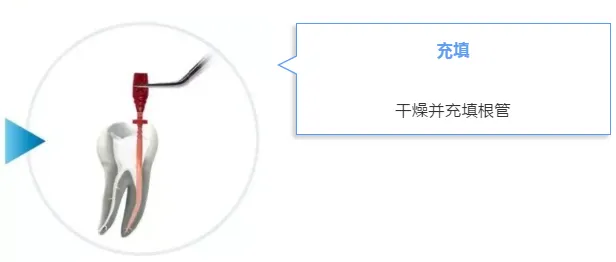 VDW EDDY 声波荡洗工作尖h.webp