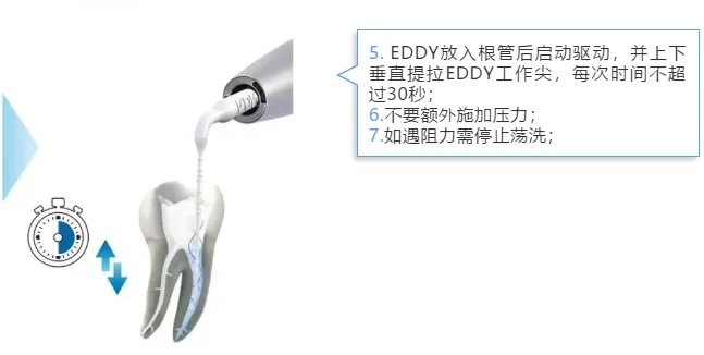 VDW EDDY 声波荡洗工作尖e.webp