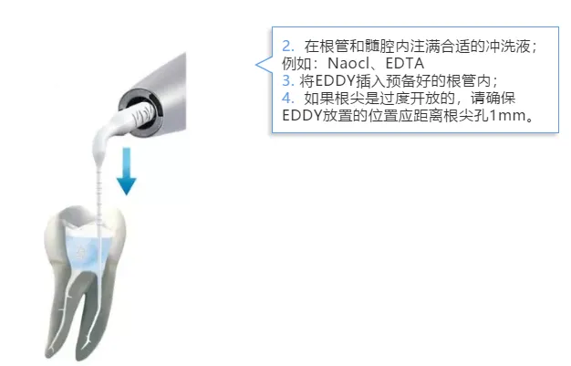 VDW EDDY 声波荡洗工作尖d.webp