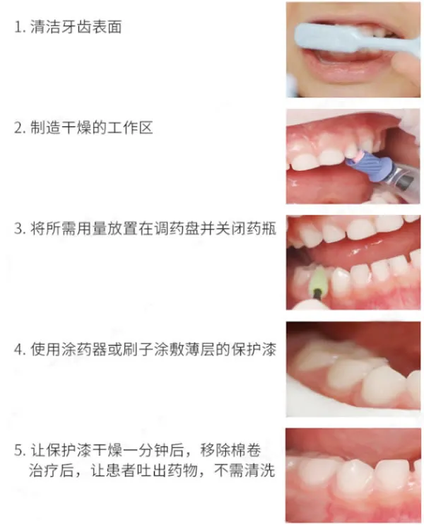 义获嘉 氟保护剂(氟齿乐.webp 义获嘉 氟保护剂(氟齿乐.webp