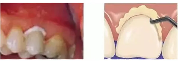 普米尔 Premier Implant Cement种植粘接剂全接触_r4_c1.webp 普米尔 Premier Implant Cement种植粘接剂全接触_r4_c1.webp