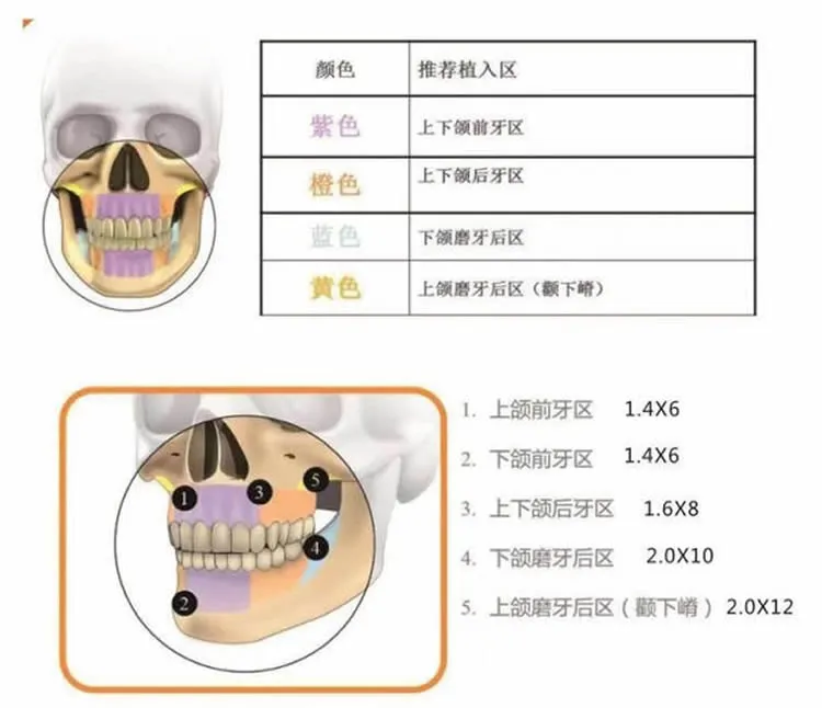 普特 PT III Plus 颅颌面接骨螺钉2_r3_c1.webp 普特 PT III Plus 颅颌面接骨螺钉2_r3_c1.webp