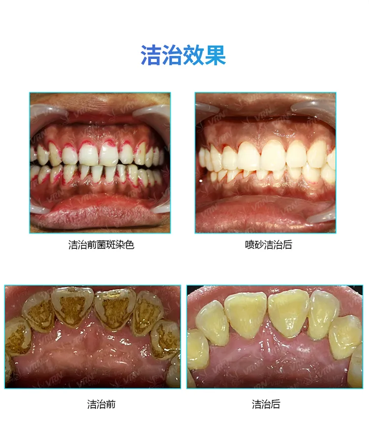 维润 超声喷砂牙周治疗仪VRN-Q61_r7_c1.webp