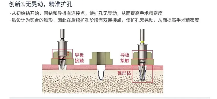 奥齿泰  导板工具盒  One Guide KIT-1_r3_c1.webp