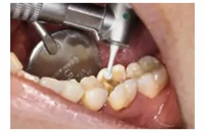 固美 陶瓷去腐车针K1SM-2.webp 固美 陶瓷去腐车针K1SM-2.webp