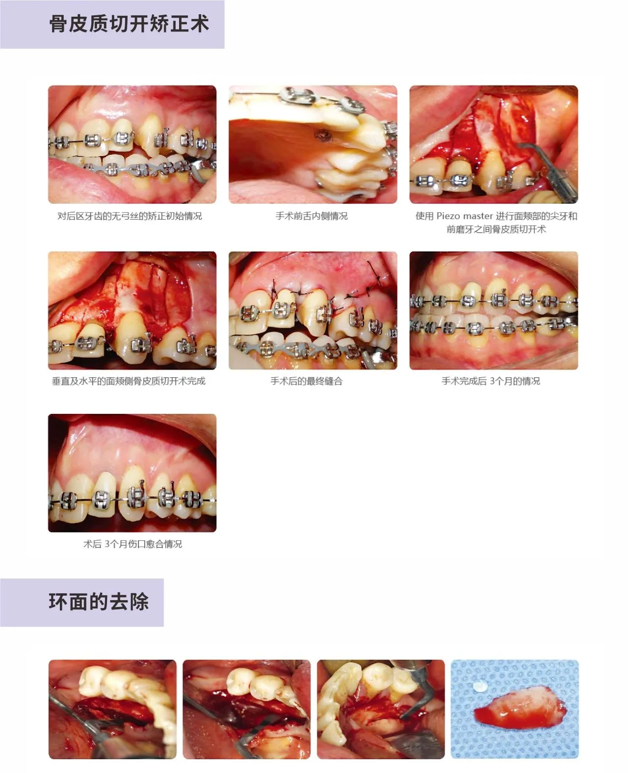 MINA 超声骨刀piezo master-16.webp