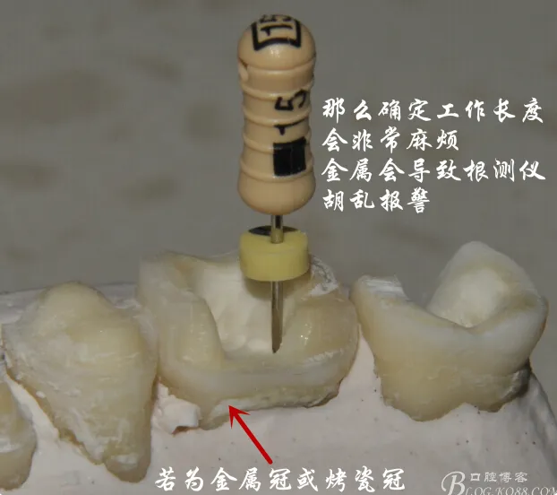 钢牙 烤瓷冠 不破冠确定工作长度(小方法）