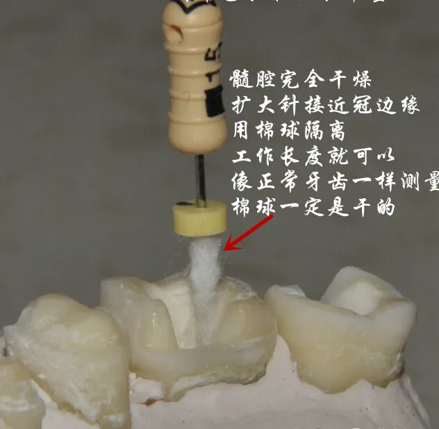 钢牙 烤瓷冠 不破冠确定工作长度(小方法）