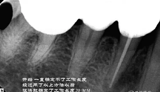 钢牙 烤瓷冠 不破冠确定工作长度(小方法）
