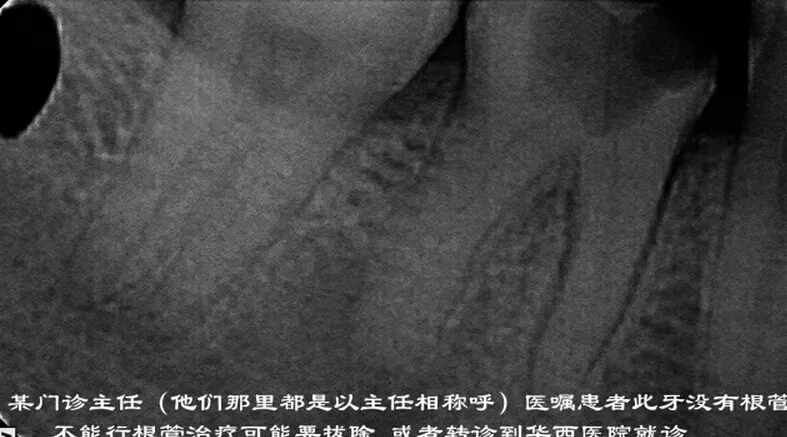 根管再 ——治疗 根管再 ——治疗