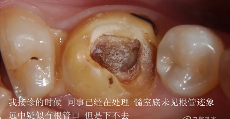 根管再 ——治疗 根管再 ——治疗