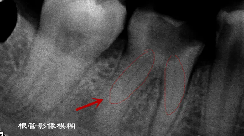 根管再 ——治疗 根管再 ——治疗