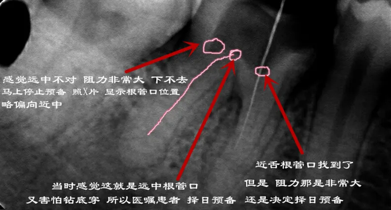 根管再 ——治疗 根管再 ——治疗