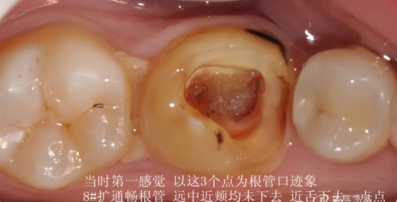 根管再 ——治疗 根管再 ——治疗