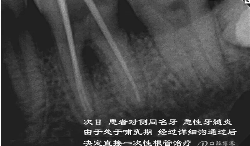 根管再 ——治疗 根管再 ——治疗