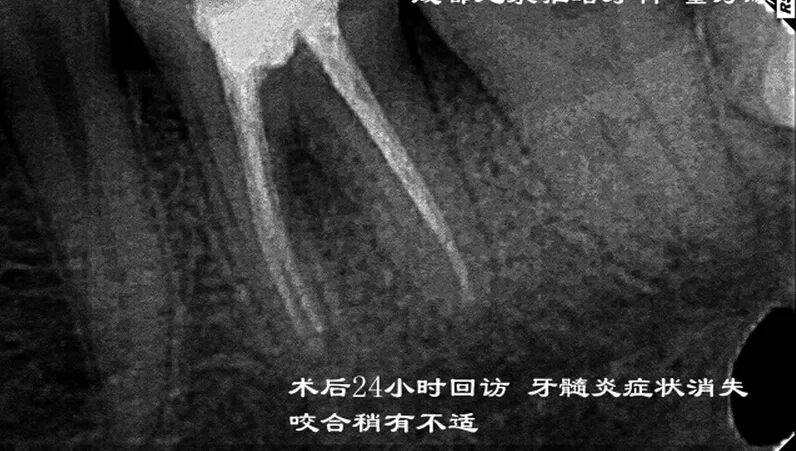 根管再 ——治疗 根管再 ——治疗