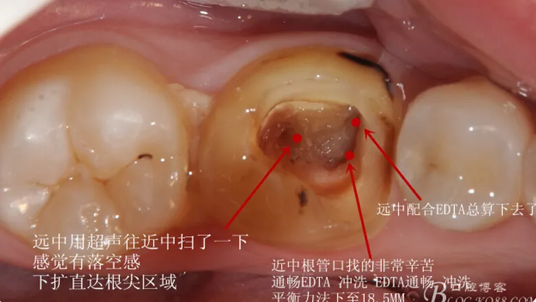 根管再 ——治疗 根管再 ——治疗