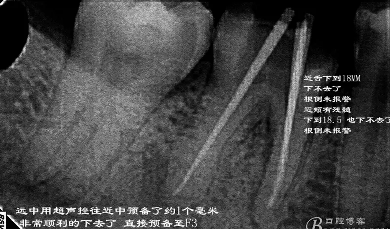 根管再 ——治疗 根管再 ——治疗