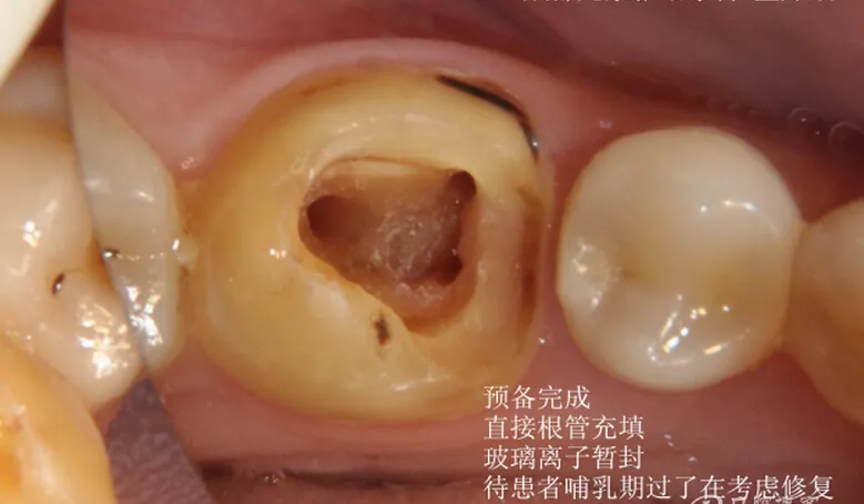 根管再 ——治疗 根管再 ——治疗